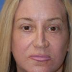 Facelift and Necklift Before & After Patient #1753
