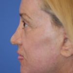 Facelift and Necklift Before & After Patient #1753