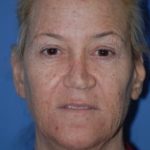 Facelift and Necklift Before & After Patient #1753