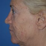 Facelift and Necklift Before & After Patient #1753