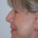 Facelift and Necklift Before & After Patient #1752