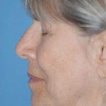 Facelift and Necklift Before & After Patient #1752
