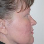 Facelift and Necklift Before & After Patient #1751