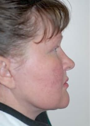 Facelift and Necklift Before & After Patient #1751