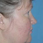 Facelift and Necklift Before & After Patient #1751