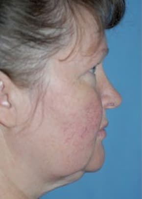 Facelift and Necklift Before & After Patient #1751