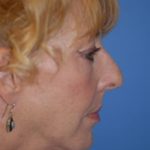Facelift and Necklift Before & After Patient #1750