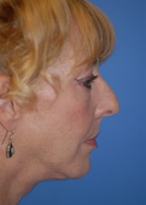 Facelift and Necklift Before & After Patient #1750