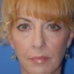 Facelift and Necklift Before & After Patient #1750