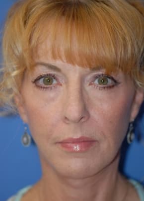 Facelift and Necklift Before & After Patient #1750