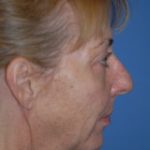 Facelift and Necklift Before & After Patient #1750