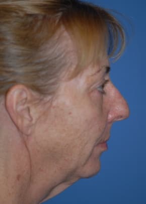 Facelift and Necklift Before & After Patient #1750