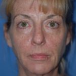 Facelift and Necklift Before & After Patient #1750