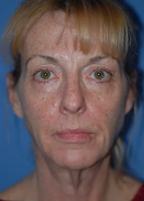 Facelift and Necklift Before & After Patient #1750