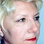 Facelift and Necklift Before & After Patient #1749