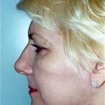 Facelift and Necklift Before & After Patient #1749