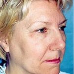 Facelift and Necklift Before & After Patient #1749