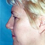Facelift and Necklift Before & After Patient #1749