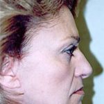Facelift and Necklift Before & After Patient #1748