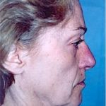 Facelift and Necklift Before & After Patient #1748