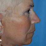 Facelift and Necklift Before & After Patient #1747