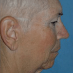 Facelift and Necklift Before & After Patient #1747