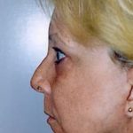 Facelift and Necklift Before & After Patient #1746