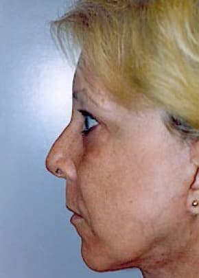 Facelift and Necklift Before & After Patient #1746
