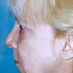 Facelift and Necklift Before & After Patient #1746