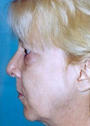 Facelift and Necklift Before & After Patient #1746
