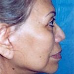 Facelift and Necklift Before & After Patient #1745