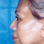 Facelift and Necklift Before & After Patient #1745