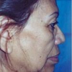 Facelift and Necklift Before & After Patient #1745