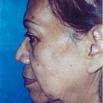 Facelift and Necklift Before & After Patient #1745