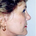 Facelift and Necklift Before & After Patient #1744