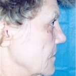 Facelift and Necklift Before & After Patient #1744