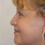 Facelift and Necklift Before & After Patient #1743