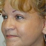 Facelift and Necklift Before & After Patient #1743