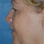 Facelift and Necklift Before & After Patient #1743