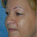 Facelift and Necklift Before & After Patient #1743