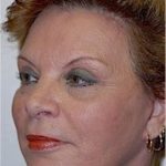 Facelift and Necklift Before & After Patient #1742