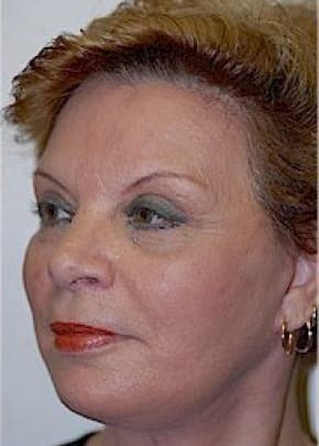 Facelift and Necklift Before & After Patient #1742