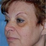 Facelift and Necklift Before & After Patient #1742