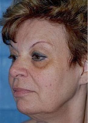Facelift and Necklift Before & After Patient #1742