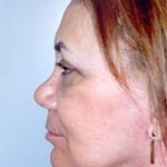 Facelift and Necklift Before & After Patient #1741