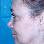 Facelift and Necklift Before & After Patient #1741