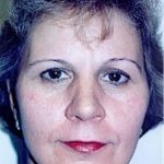Facelift and Necklift Before & After Patient #1740