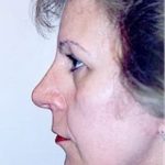 Facelift and Necklift Before & After Patient #1740