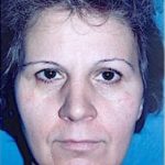 Facelift and Necklift Before & After Patient #1740