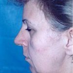 Facelift and Necklift Before & After Patient #1740